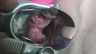 close up speculum and internal veiw of squirting